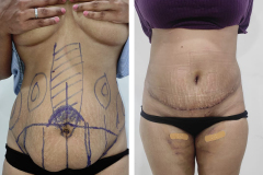 Abdominoplasty-1-1