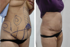 Abdominoplasty-2-1