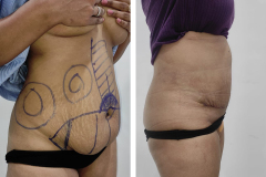 Abdominoplasty-3-1