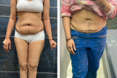 Abdominoplasty-1-2