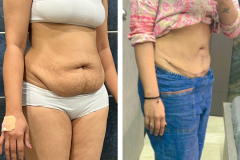 Abdominoplasty-2-2