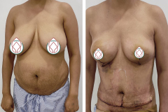 Abdominoplasty-1