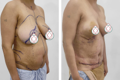 Breast-Reduction-Surgery-2