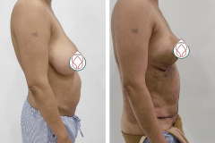 Breast-Reduction-Surgery-3