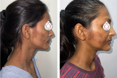 FACIAL FAT GRAFTING