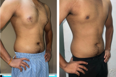 Gynecomastia-2-