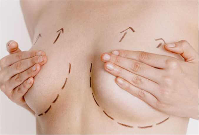 Breast Lift Surgery Benefits