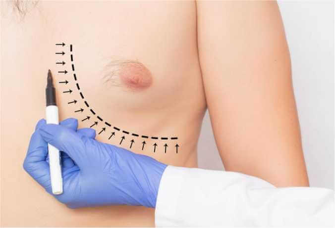 Benefits of Gynaecomastia Surgery