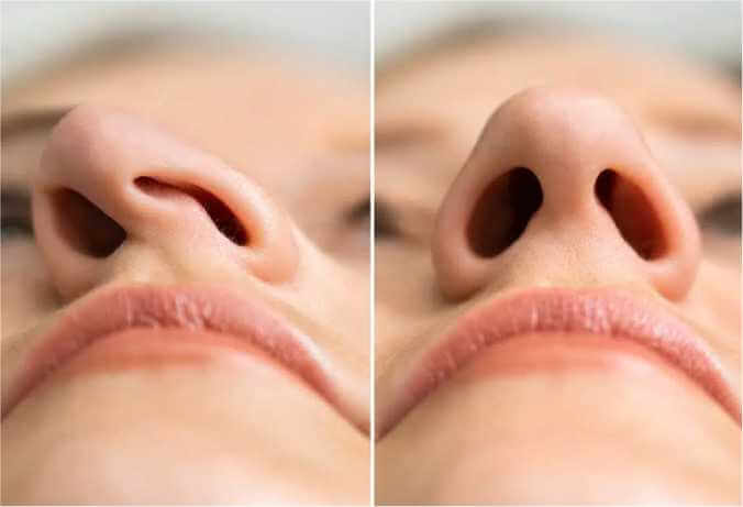 Benefits of Rhinoplasty