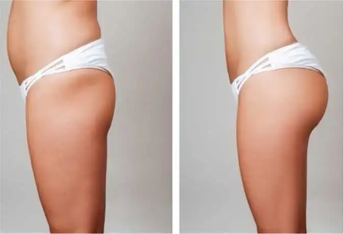 Benefits of a Brazilian Buttock Lift