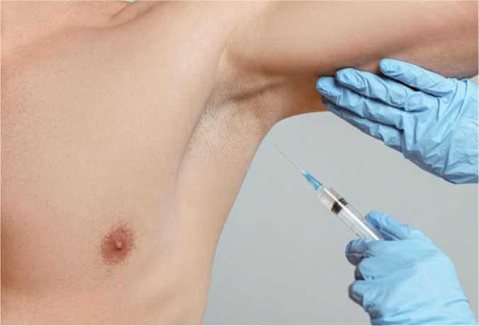 Benefits of Excessive Sweating Treatment