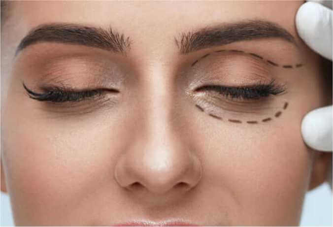 Benefits of Eyelid Surgery
