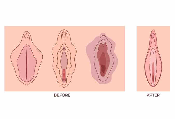 Benefits of Labia Reduction