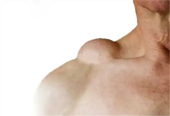 Benefits of Lipoma Removal Surgery