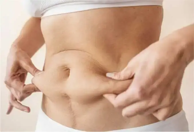 Benefits of a Mommy Makeover