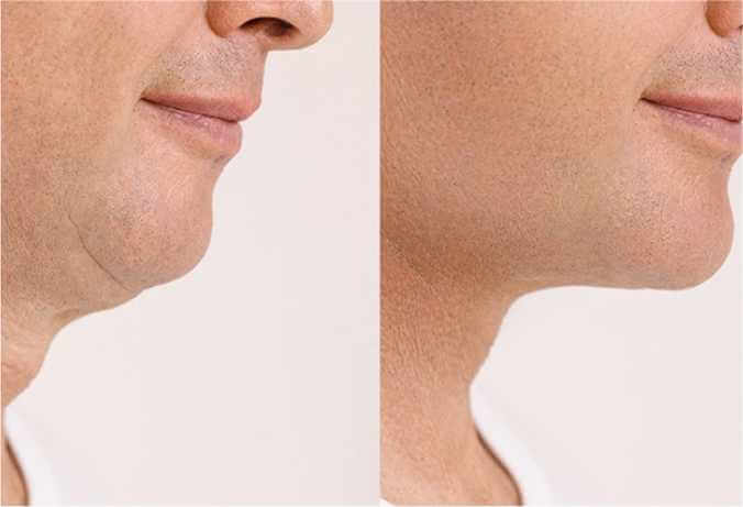 Benefits of a Neck Lift