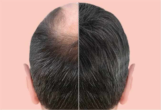 Benefits of PRP Treatment