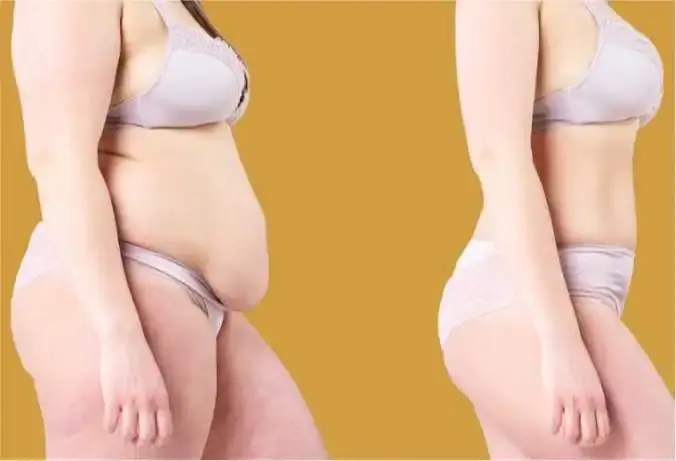 Benefits of a Tummy Tuck