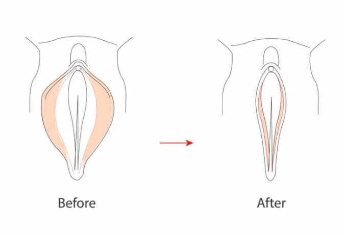Benefits of Vaginal Tightening