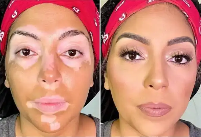 Benefits of Vitiligo Treatment at Elysian Plastic Surgery