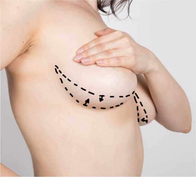 Ideal candidate for this surgery/procedure