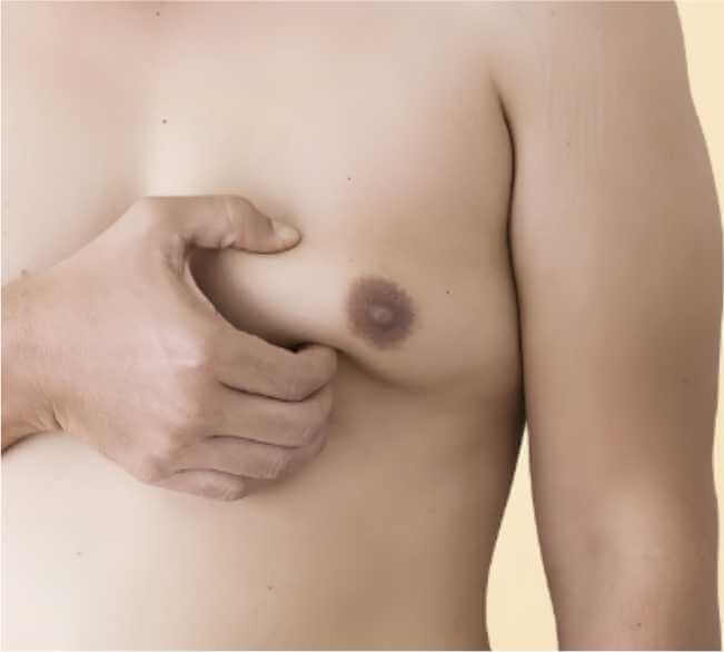 Ideal Candidates for Gynaecomastia Surgery