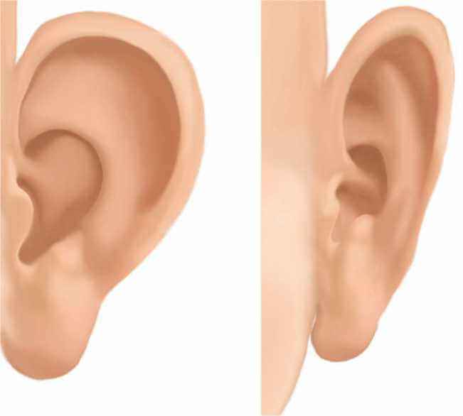The Ideal Candidate for Ear Correction Surgery