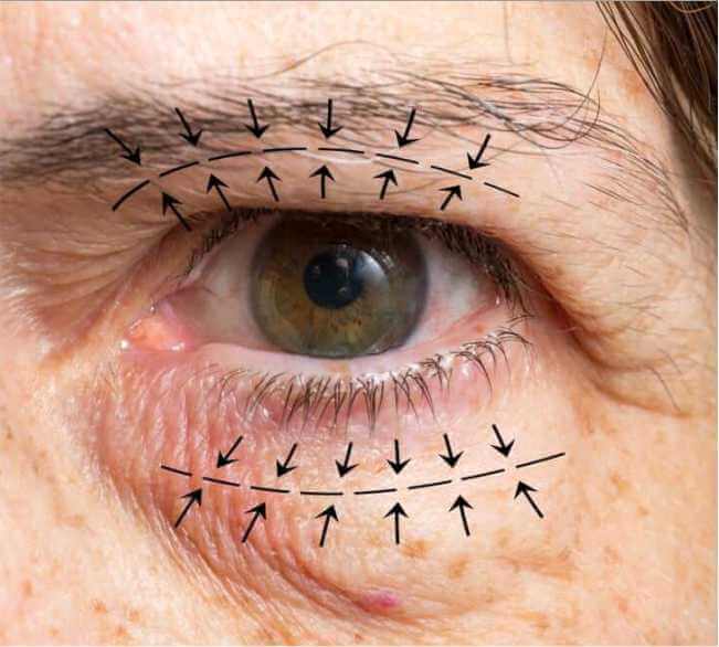 Ideal Candidates for Eyelid Surgery