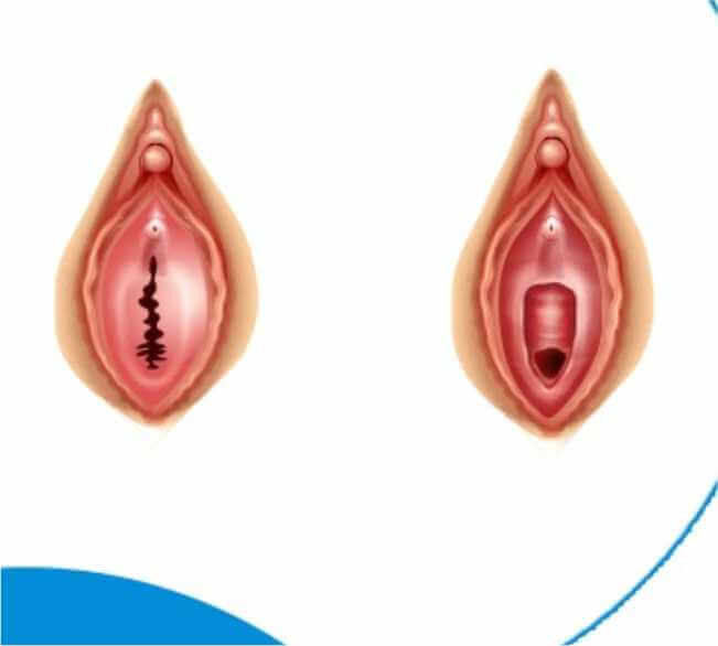 Ideal Candidates for Hymenoplasty