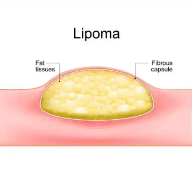 Ideal Candidates for Lipoma Removal Surgery
