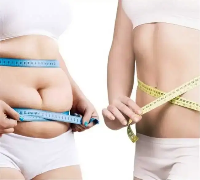 Ideal Candidates for Liposuction