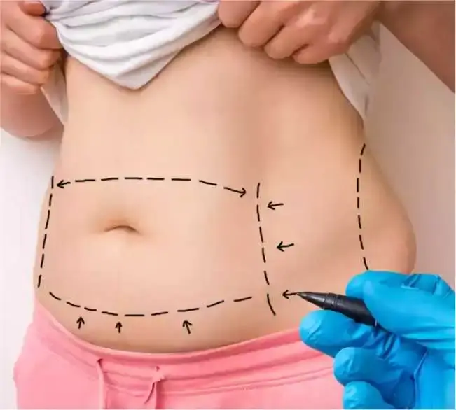 Ideal Candidates for Mommy Makeover Surgery