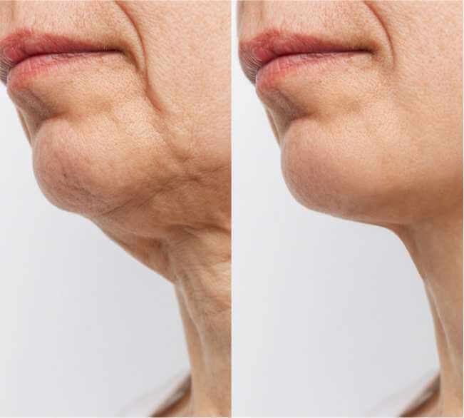 Ideal Candidate for Neck Lift Surgery