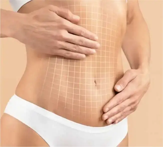 The Ideal Candidate for Tummy Tuck Surgery