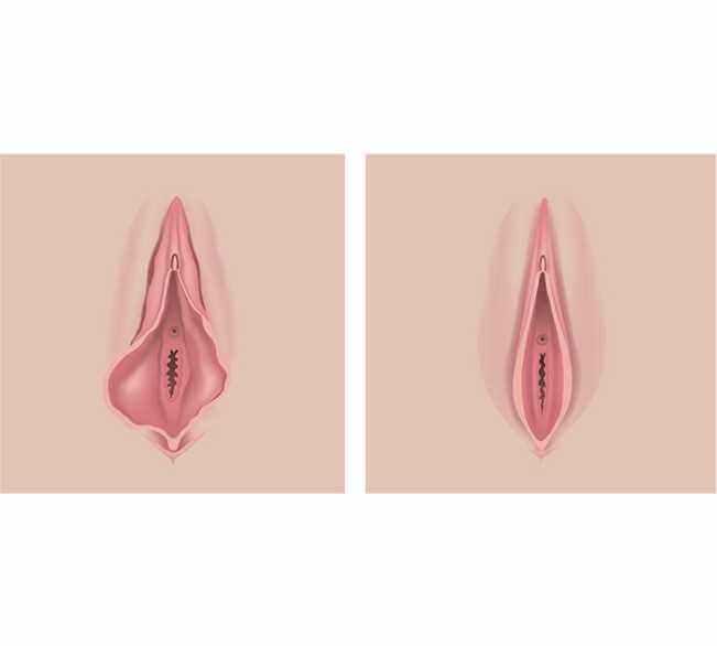 Ideal Candidates for Vaginal Tightening