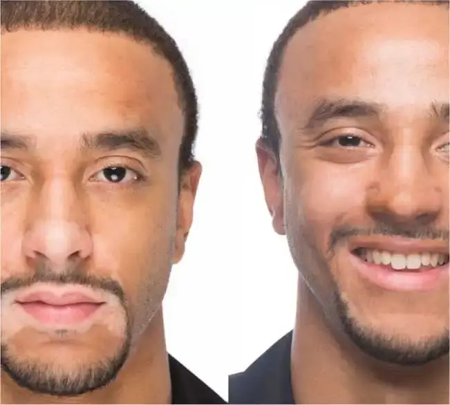 Ideal Candidates for Vitiligo Treatment