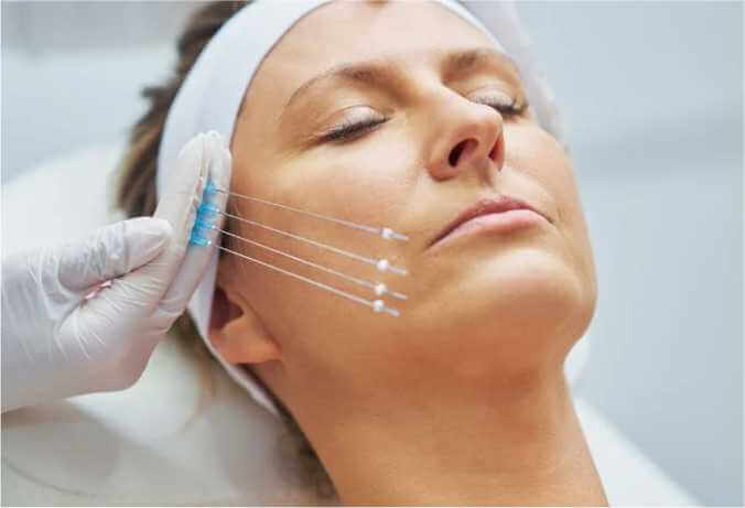 Benefits Of Thread Lift Surgery