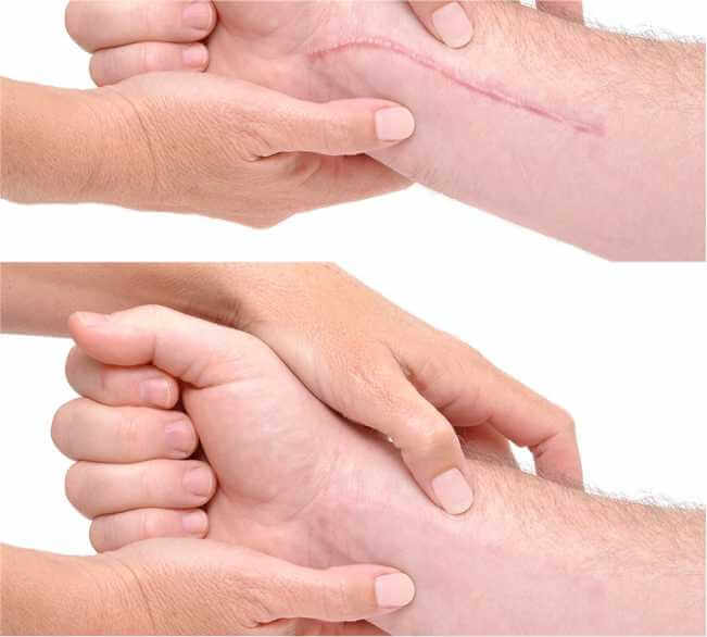 Ideal Candidates for Scar Revision Surgery