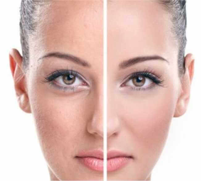 Ideal Candidates for Cheek Reduction