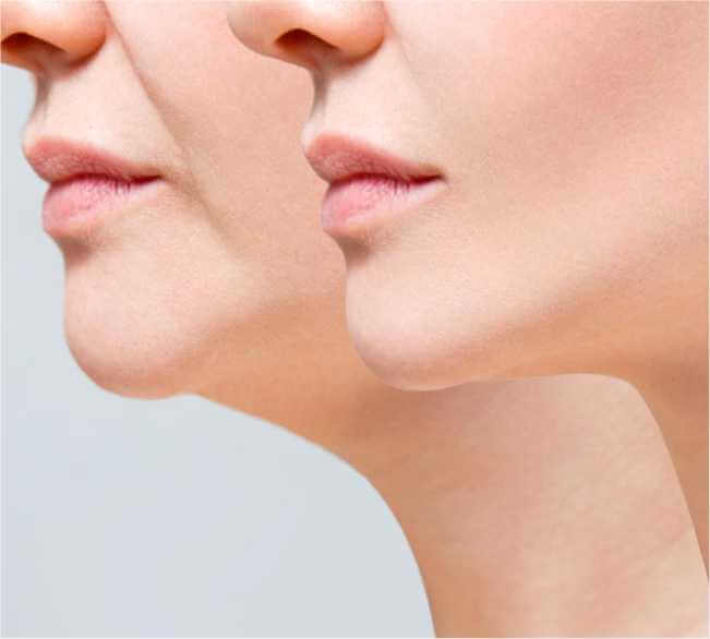 Ideal Candidates for Chin Augmentation Surgery