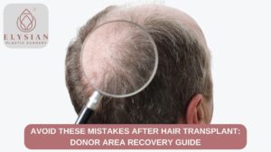 hair transplant in Surat