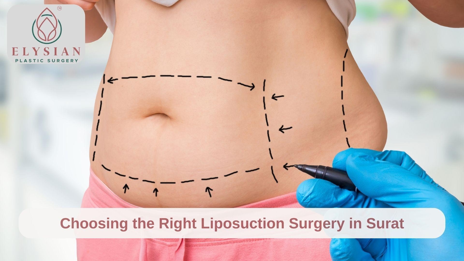 Best Liposuction Surgery in Surat