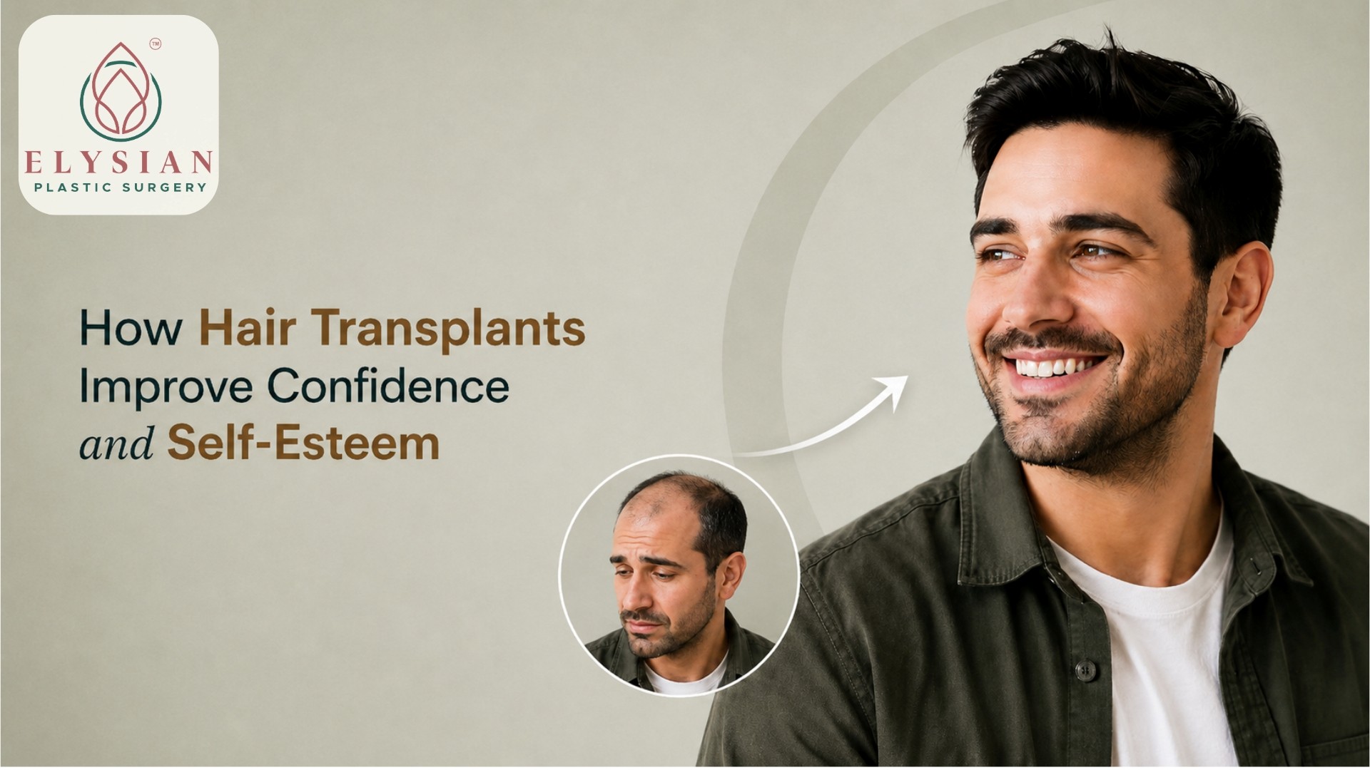 Best Hair Transplant in Surat⁠